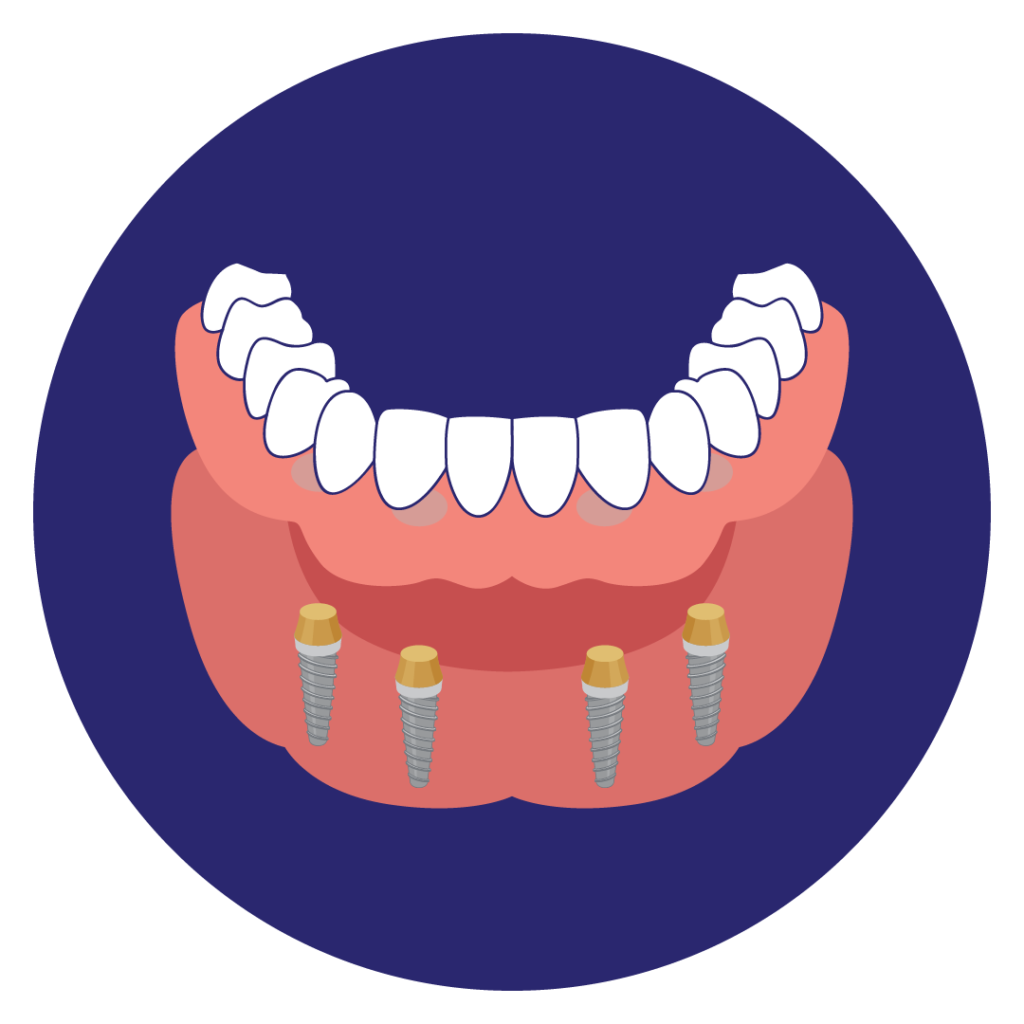 Overdentures: Locatorprothesen und Stegprothesen