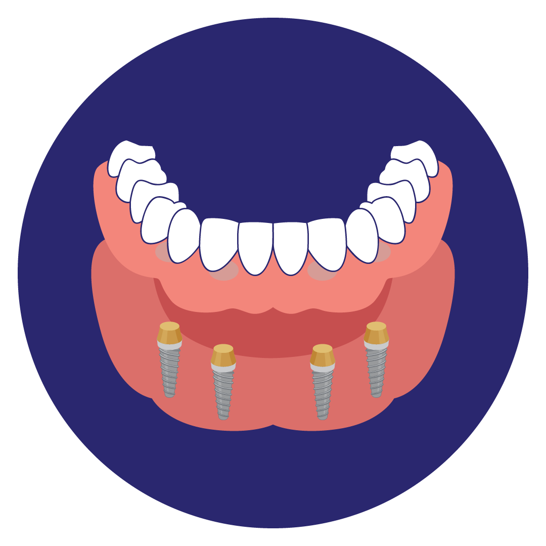 Overdentures: Locatorprothesen und Stegprothesen